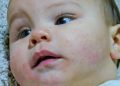 Tips for Managing Baby’s Eczema and Skin Conditions: A Parent’s Guide