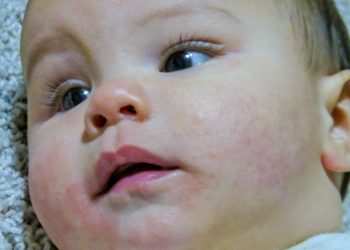 Tips for Managing Baby’s Eczema and Skin Conditions: A Parent’s Guide