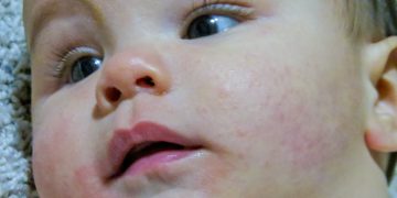 Tips for Managing Baby’s Eczema and Skin Conditions: A Parent’s Guide