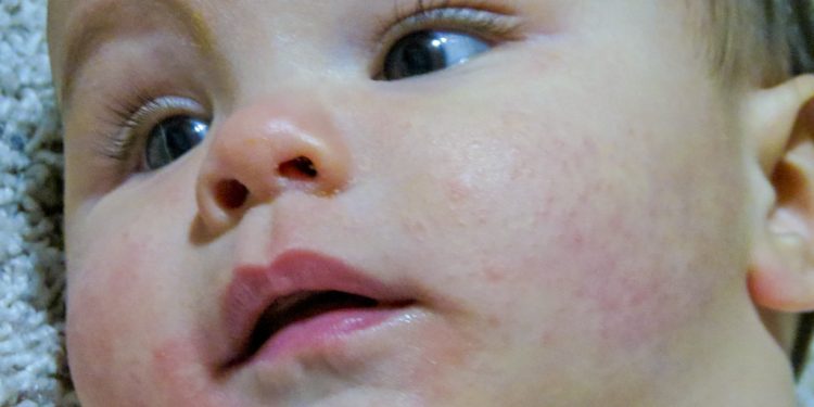 Tips for Managing Baby’s Eczema and Skin Conditions: A Parent’s Guide Tips for Managing Baby’s Eczema and Skin Conditions: A Parent’s Guide