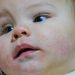 Tips for Managing Baby’s Eczema and Skin Conditions: A Parent’s Guide Tips for Managing Baby’s Eczema and Skin Conditions: A Parent’s Guide